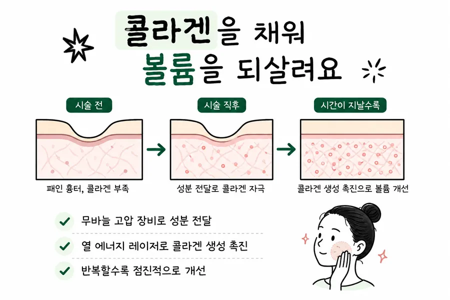 Illustration of collagen replenishment for a wide, gently sloping acne scar and how the skin cross-section changes over time