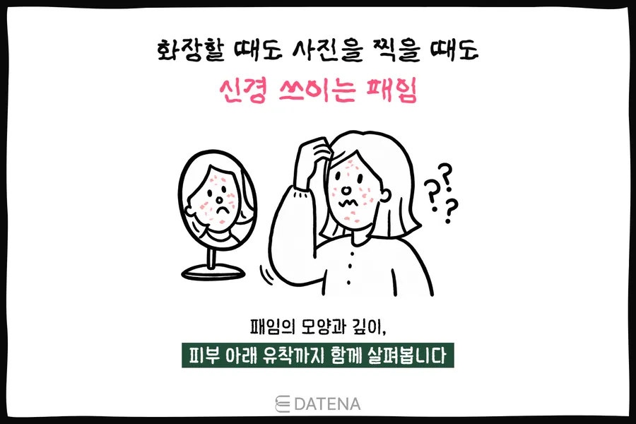 A woman examining sunken acne scars on her cheek in a mirror, with illustrations of depressions that bother her in makeup and photos