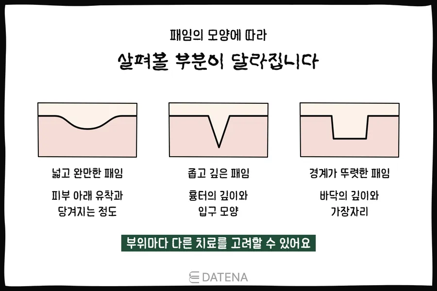 Skin cross-section illustration comparing wide, gently sloped depressions, narrow deep depressions, and sharply defined depressions