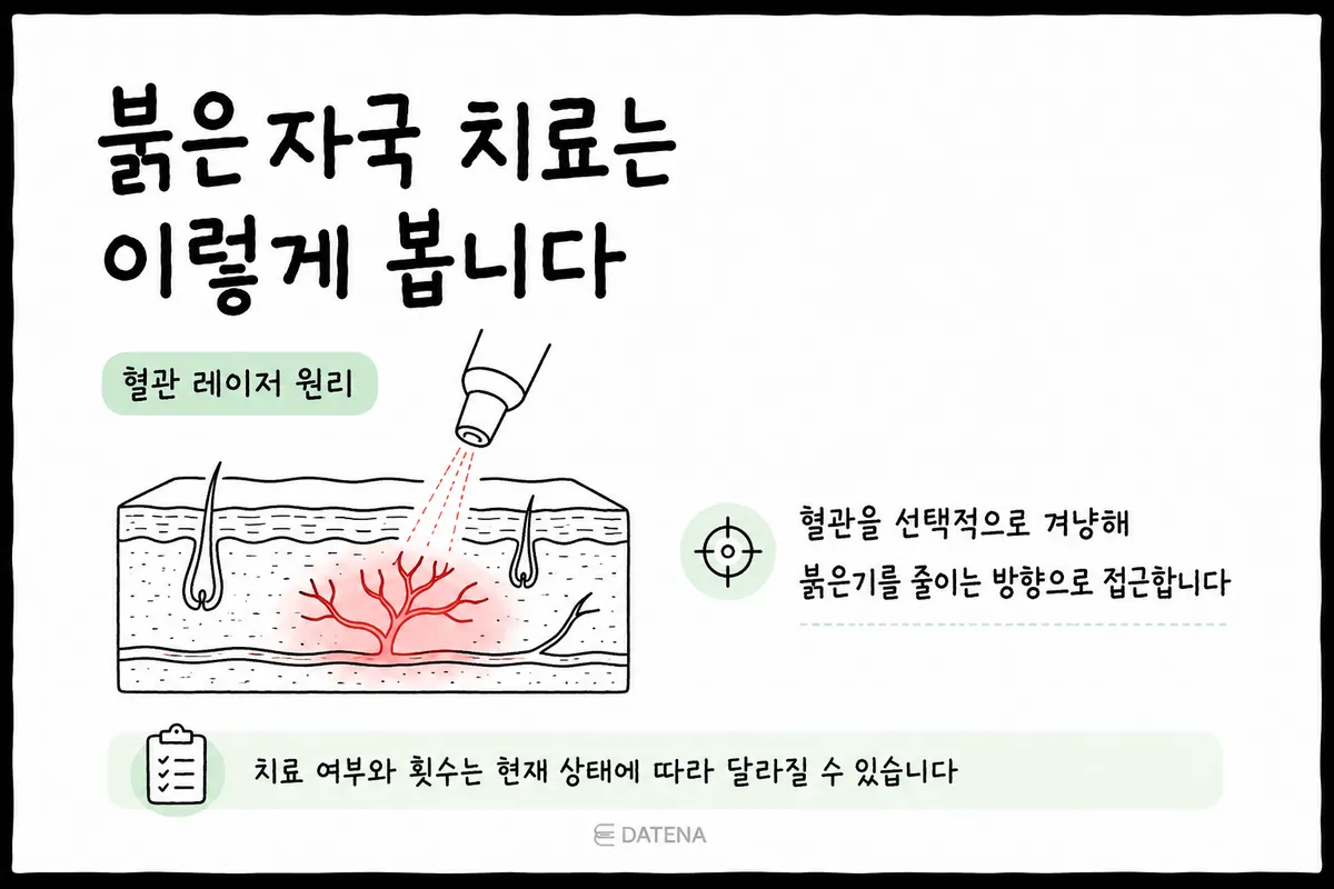 Illustration of how a vascular laser targets the dilated blood vessels in red acne marks