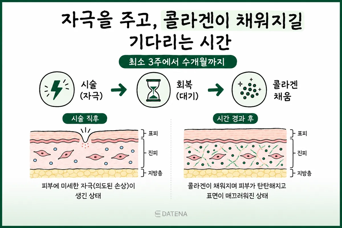 Cross-section diagram of skin going from irritation right after treatment, through recovery, to collagen filling in