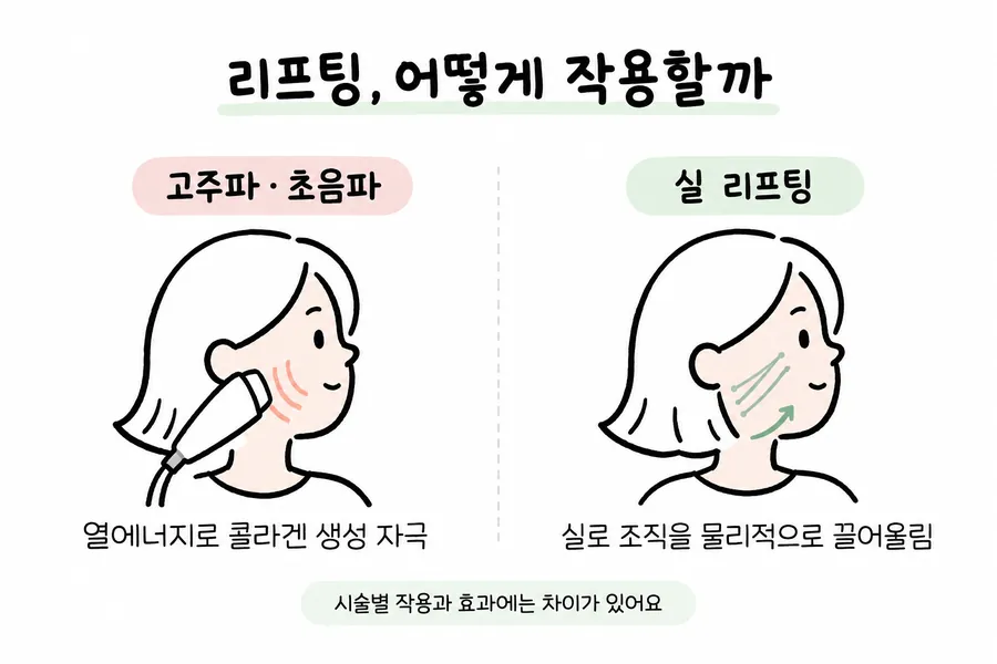 Facial illustration comparing how radiofrequency/ultrasound lifting and thread lifting work